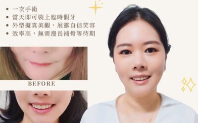 All-on-4/6 全口植牙案例