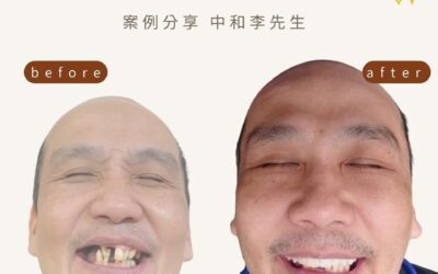 All-on-4 全口植牙案例