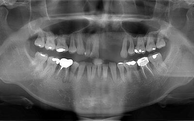 牙周病植牙/補骨手術/全口重建過程，循序漸進恢復口腔健康