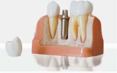 植體覆蓋式全口活動假牙🦷