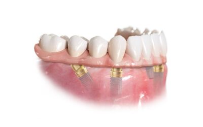 All-on-4 / All-on-6 一日全口速定植牙 ⚡