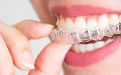 🦷 矯正治療怎麼選？