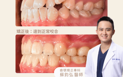 🦷 齒顎矯正案例|高位虎牙改善