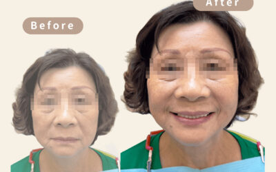 🌸 重現年輕自信笑容|All-on-4 上顎重建案例分享