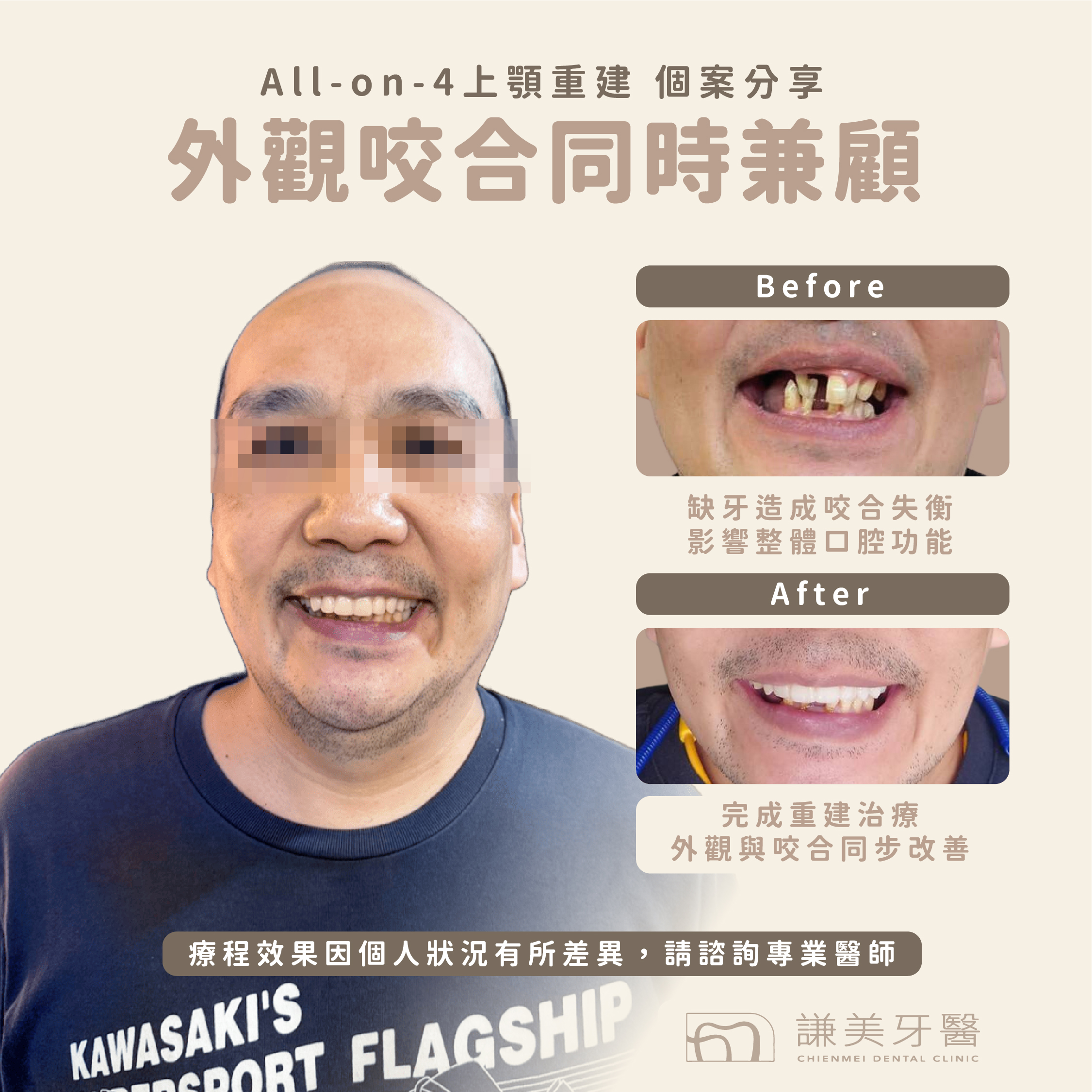 260625_叔叔_上顎_allon4_案例-01