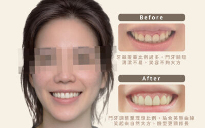 ⭐ 調整微笑視覺平衡|鐳射牙冠增長術案例分享