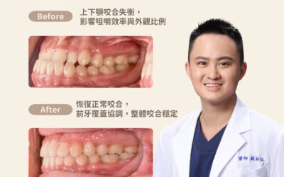 🦷 齒顎矯正案例|咬合不正造成戽斗