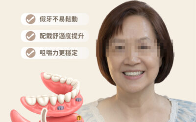 🦷 植體覆蓋式全口活動假牙|個案分享