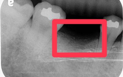 今天分享一個真實案例,不誇張,是臨床上實際遇到的狀況…