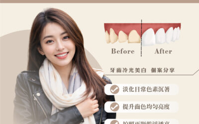 🦷 牙齒冷光美白｜個案分享